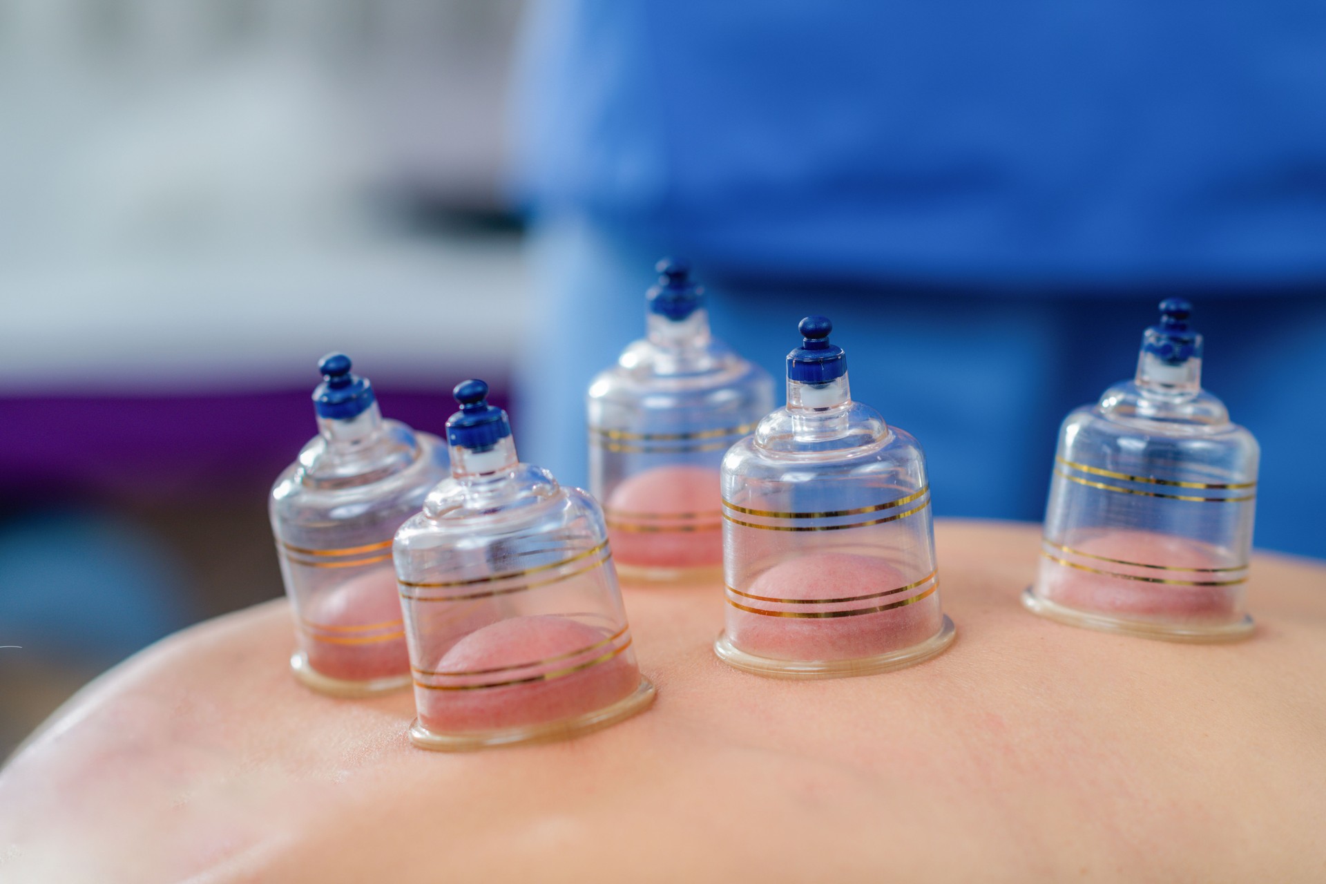 Woman receiving cupping therapy on her back during a physical therapy session. The suction cups help relieve muscle tension, improve circulation, and promote pain relief and relaxation.