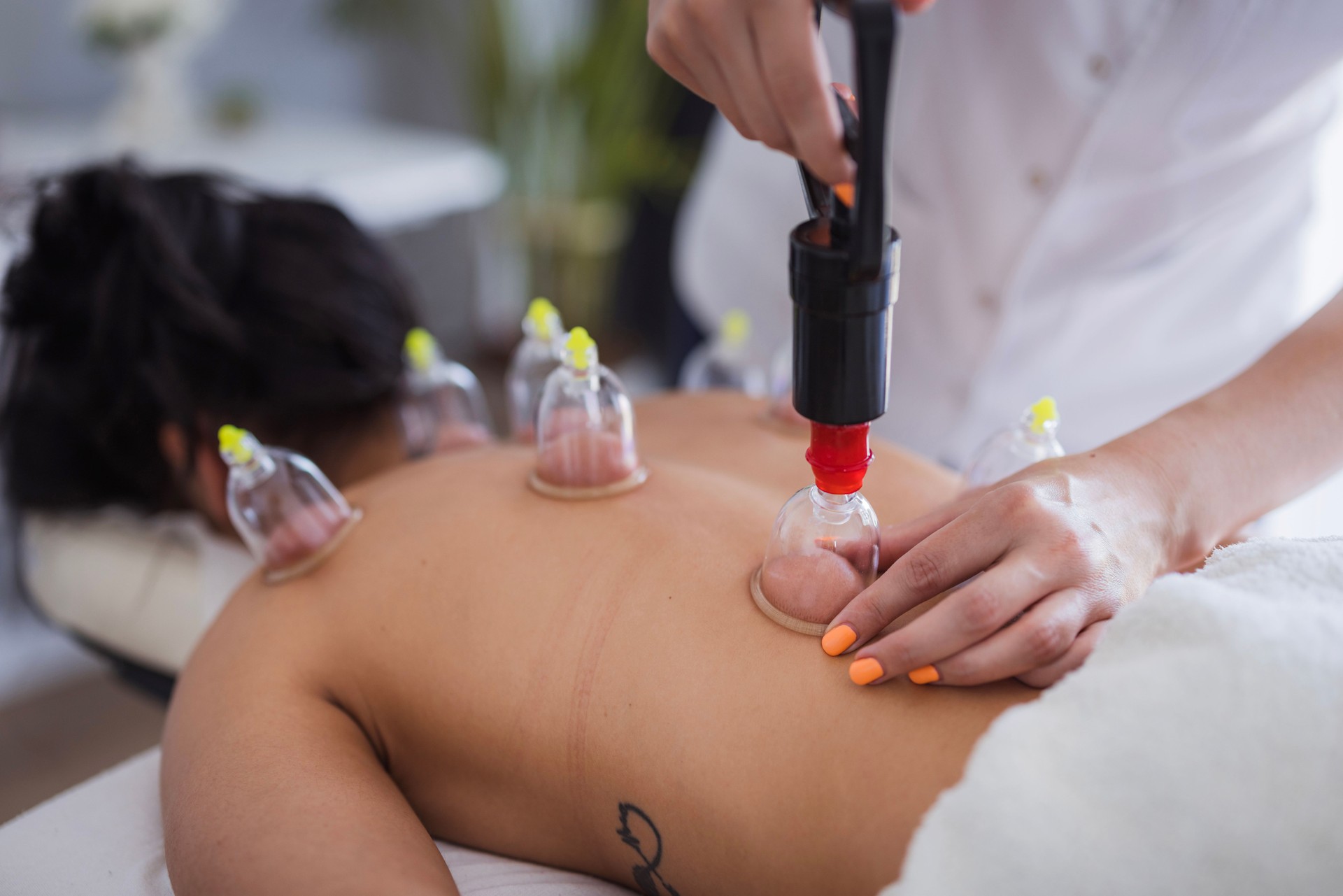 Therapist performing blood suction with cups