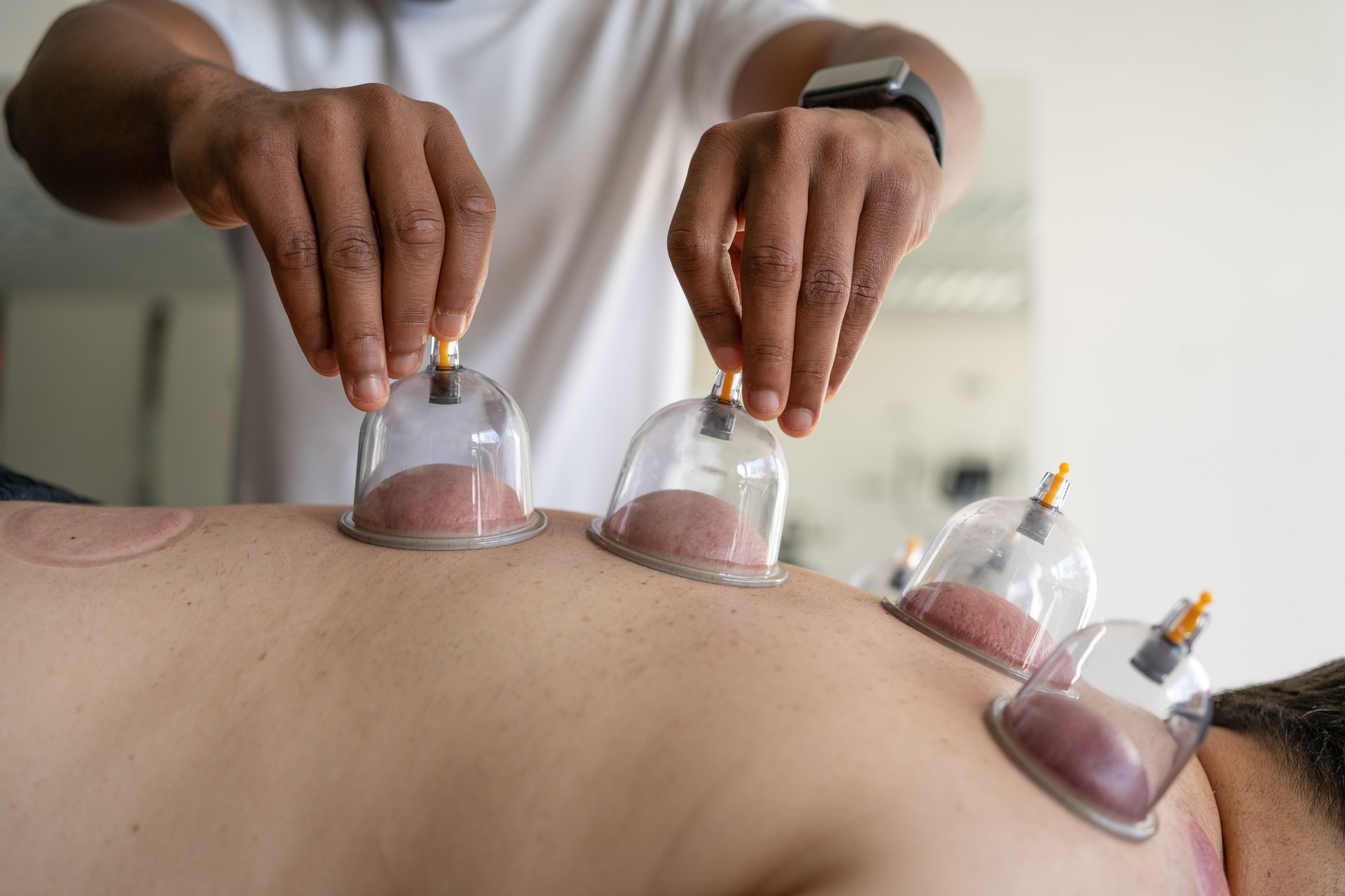 Professional performing vacuum cupping therapy on a client